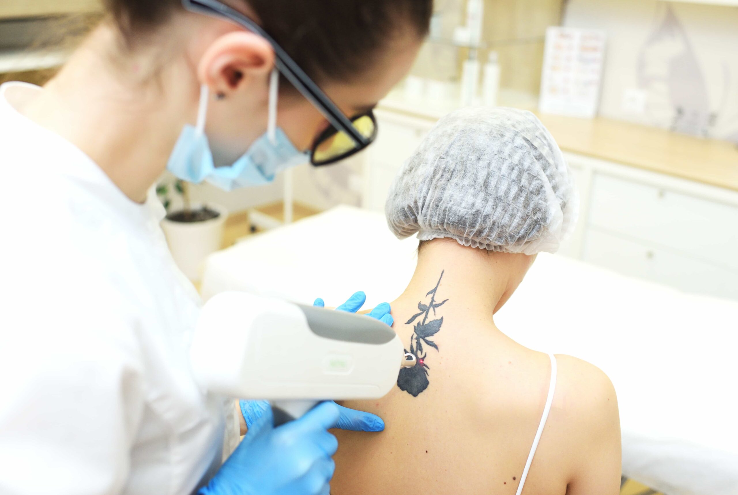 A masked laser technician wearing safety goggles performing tattoo removal on a black floral tattoo located on a client's upper back using a handheld laser device.