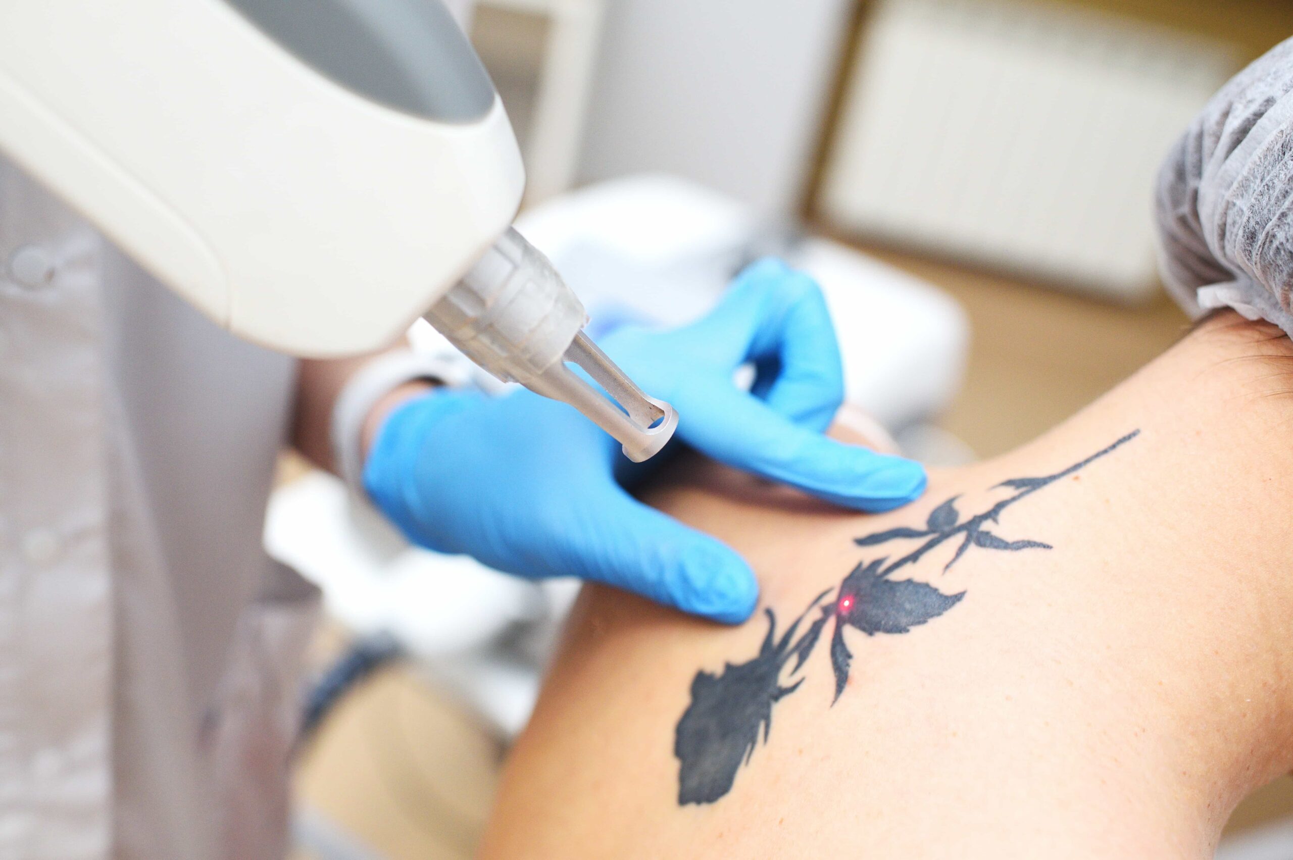Close-up of a professional in blue gloves using a laser device to perform tattoo removal on a large black rose tattoo located on a client's shoulder.